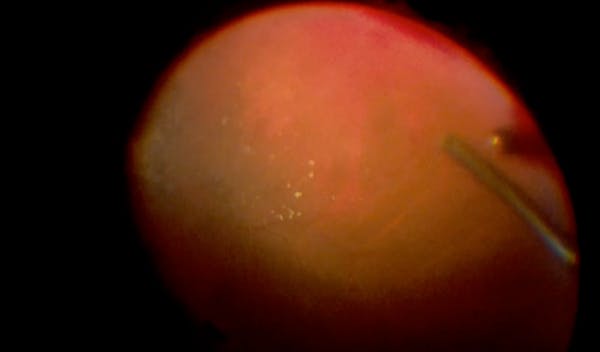 Lens-Sparing Vitrectomy for Dense Diabetic Vitreous Hemorrhage thumbnail
