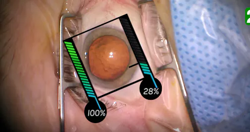 Techniques for Clear Corneal Incisions