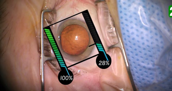 Techniques for Clear Corneal Incisions thumbnail