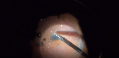 Long-Standing Retinal Detachment and Subretinal Trocar