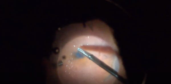 Long-Standing Retinal Detachment and Subretinal Trocar thumbnail