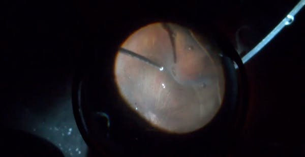 PVR Retinal Detachment With Poor Functional Outcome thumbnail