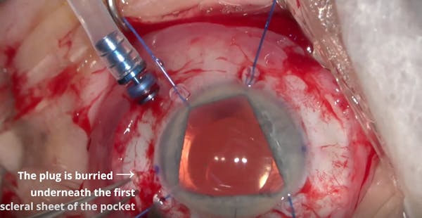 Dislocated IOL and Secondary Sutureless Scleral-Fixated IOL thumbnail