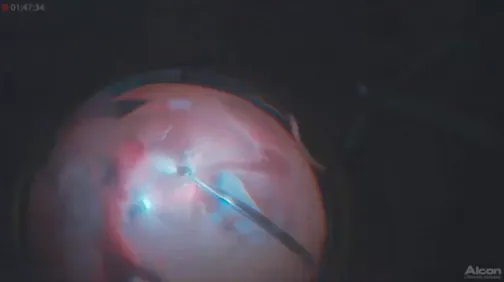 Traumatic Hemorrhagic Retinal Detachment