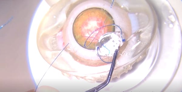 Double-Flanged Polypropylene Technique thumbnail