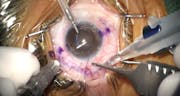 Sleeve-Assisted Flanged Intrascleral IOL Fixation