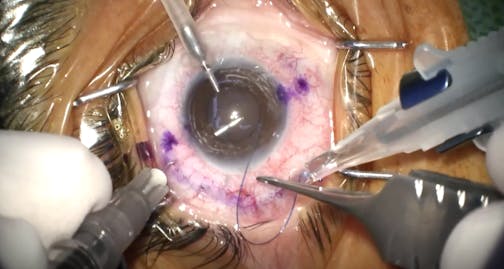 Sleeve-Assisted Flanged Intrascleral IOL Fixation