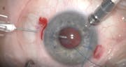 Double Flange Technique for Toric and Multifocal IOLs