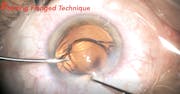 Piercing Flanged IOL Fixation Technique
