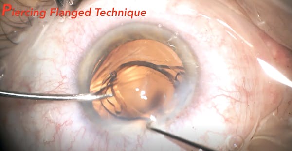 Piercing Flanged IOL Fixation Technique thumbnail