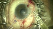 Using an Injector With a Flange Technique for IOL Fixation