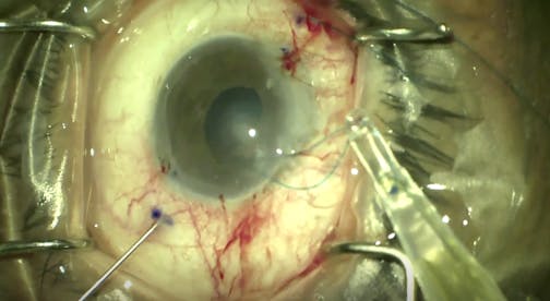 Using an Injector With a Flange Technique for IOL Fixation