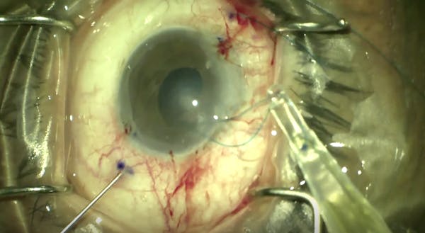 Using an Injector With a Flange Technique for IOL Fixation thumbnail