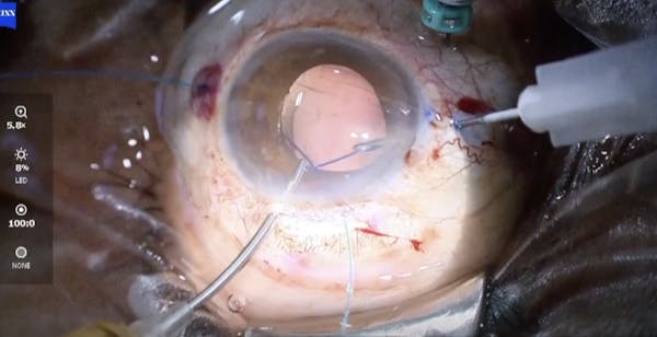 New IOL Design for Flange Techniques thumbnail
