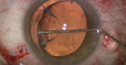 Flange Technique for IOL Fixation With Ahmed Segment