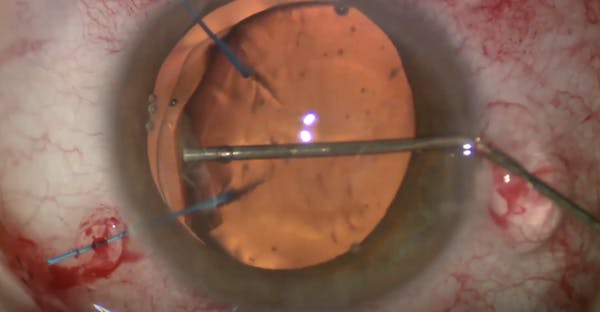 Flange Technique for IOL Fixation With Ahmed Segment thumbnail