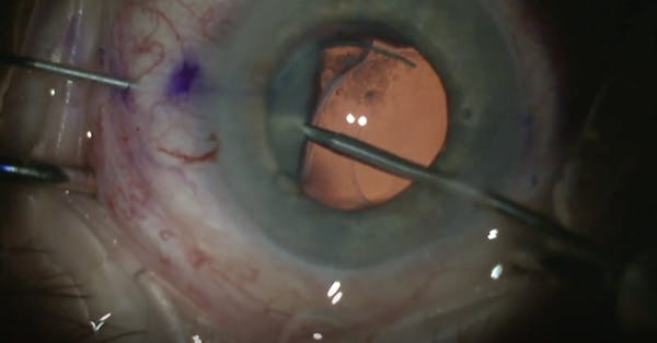 Belt-Loop Technique for Dislocated IOLs thumbnail