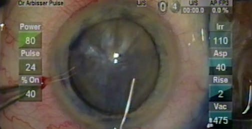 Unilateral Hypermature Tan Cataract
