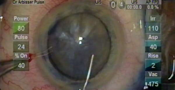 Hypermature Brunescent Cataract thumbnail