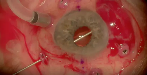 Transconjunctival Sutureless Intrascleral (SIS) Fixation Using Trocar Cannulas