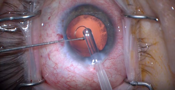 Capsular Tension Ring Insertion Pearls: Using a Sinskey Hook thumbnail