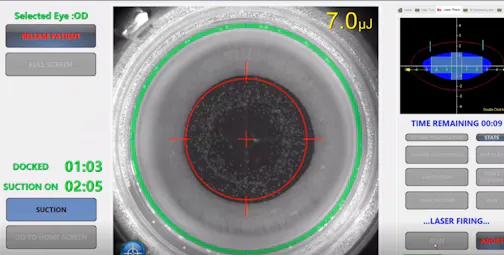 Toric IOL Placement Utilizing LENSAR IntelliAxis-L