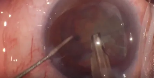 No Ultrasound Sub Chop
