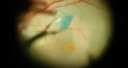 Improving Visualization With Triamcinolone Acetonide, ICG, and Trypan Blue