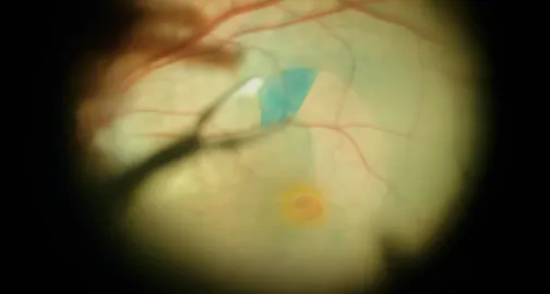 Improving Visualization With Triamcinolone Acetonide, ICG, and Trypan Blue