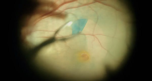 Improving Visualization With Triamcinolone Acetonide, ICG, and Trypan Blue thumbnail