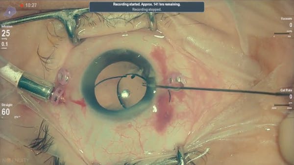 Modified Yamane Technique for a Dislocated Three-Piece IOL thumbnail