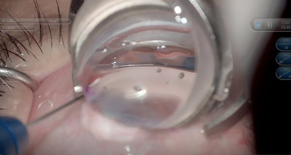 Pearls for Success With a “Cheat Code” for MIGS Placement thumbnail
