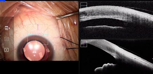 Canal Dilation With iStent Using Intraoperative OCT