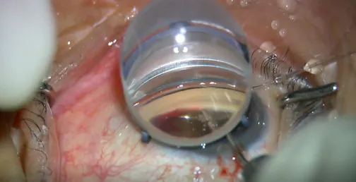 Triple-T Surgery for Advanced POAG