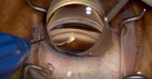 Stress-Free Hydrus Implantation