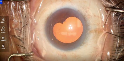 Kahook Dual Blade Goniotomy