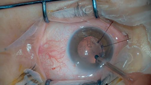 3D Cataract Subluxation