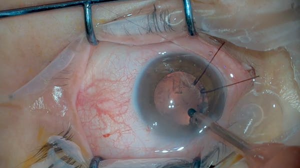 3D Cataract Subluxation thumbnail