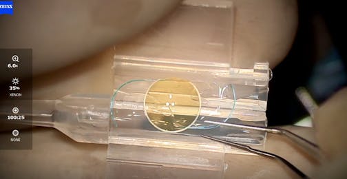 Light Adjustable Lens Loading and Implantation