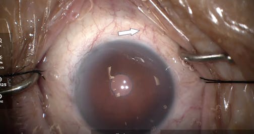 iStent Infinite With Fluid Wave