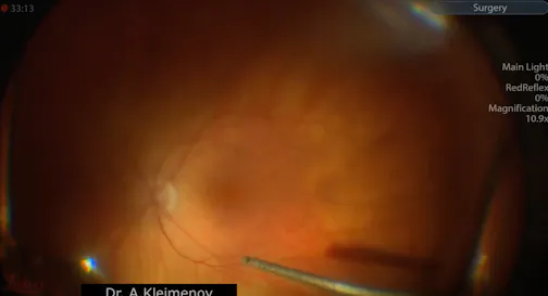 Long-Term Results of Macular Hole Surgery Without Postoperative Vitreous Cavity Tamponade