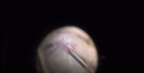 Surgical Management of CRVO