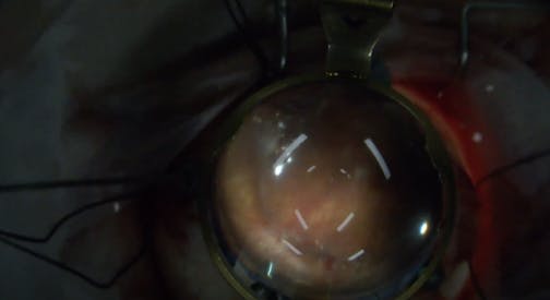 Encircling Element at the End of Vitrectomy