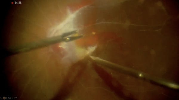 Bimanual Technique for Diabetic TRD thumbnail