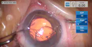 Piggyback Technique Using an Aspheric Silicone Three-Piece IOL