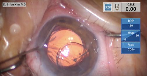 Piggyback Technique Using an Aspheric Silicone Three-Piece IOL