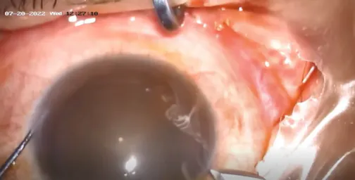 Safe Phaco in the Presence of Extreme Eye Movement