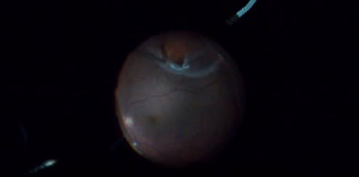 Retinal Detachment With PVR Stage B