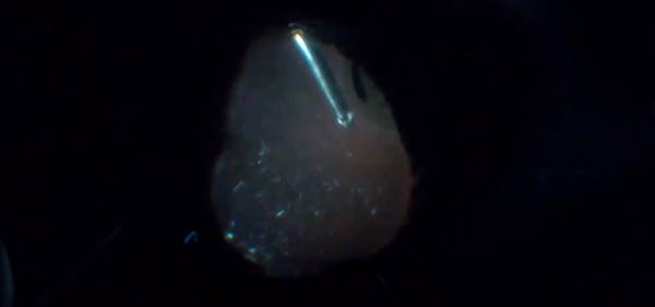 Triple Procedure for a Traumatized Eye thumbnail
