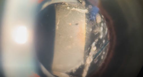 Calcified Silicone IOL Exchange